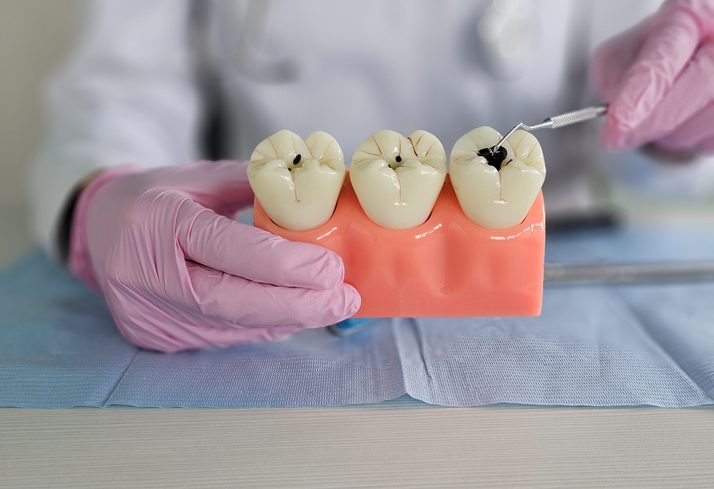 causas de las caries